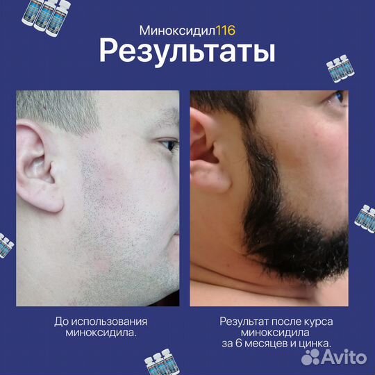 Миноксидил Оригинал (5, 10, 15 и 16 процентов)