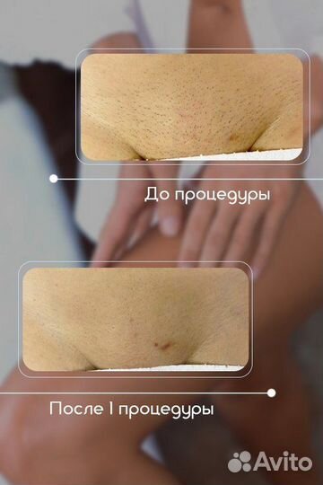 Студия лазерной эпиляции