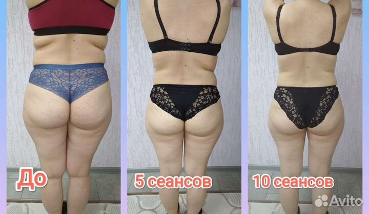 Антицеллюлитный массаж