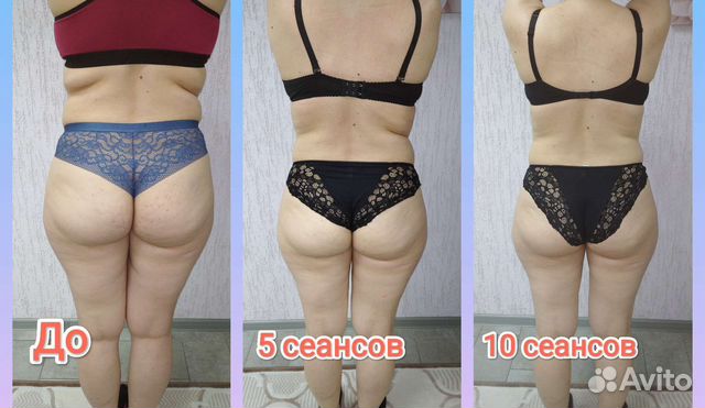 Антицеллюлитный массаж