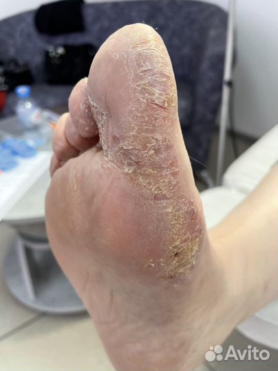 Препаратно-аппаратный педикюр Kane