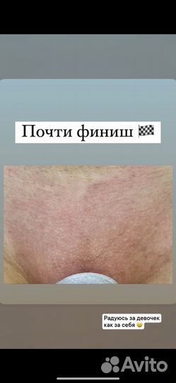 Электроэпиляция