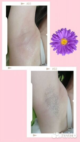 Депиляция (шугаринг)