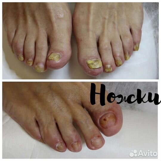 Лечебный педикюр