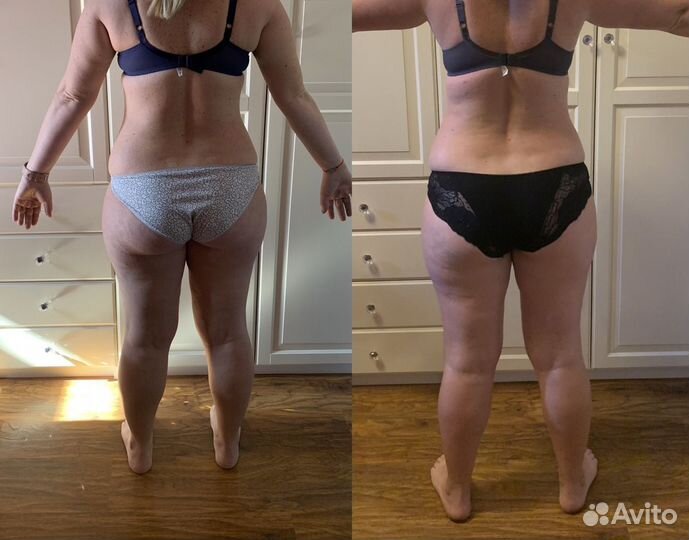 Антицеллюлитный массаж