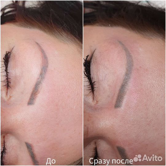 Лазерное удаление татуажа