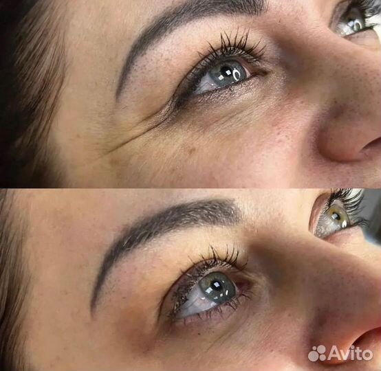 Ботулинотерапия / ботокс лба и межбровки