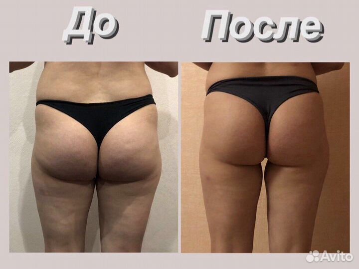 Массаж. Мадеротерапия.Ручная Липопластика