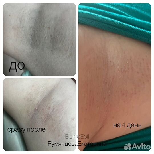 Электроэпиляция