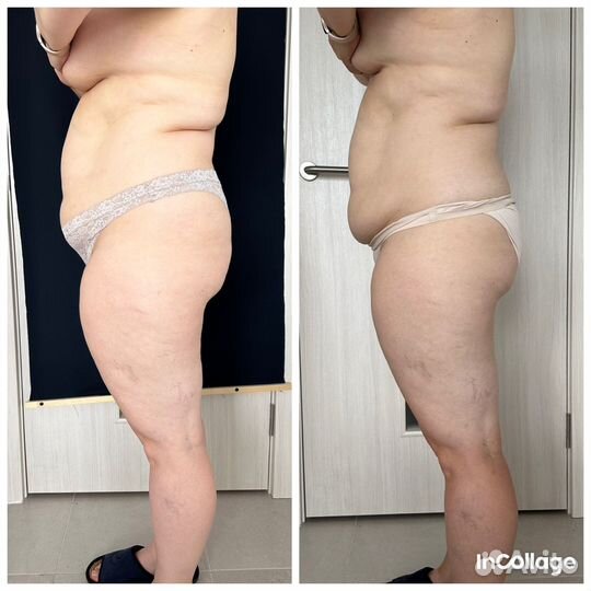 Антицеллюлитный массаж