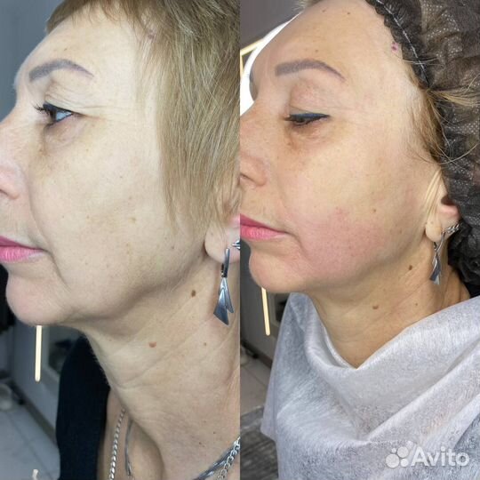 Модели SMAS лифтинг