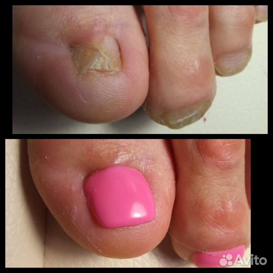 Подолог, лечебный педикюр