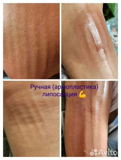 Антицеллюлитный массаж/ручная липосакция