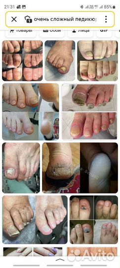 Сложный педикюр трещины вросший ноготь ищу модель