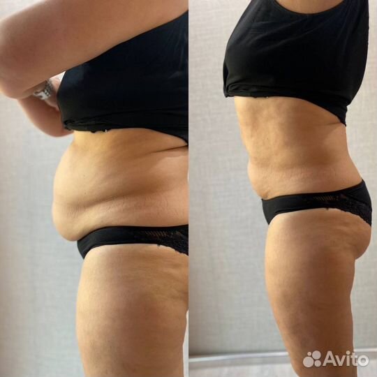 Антицеллюлитный массаж