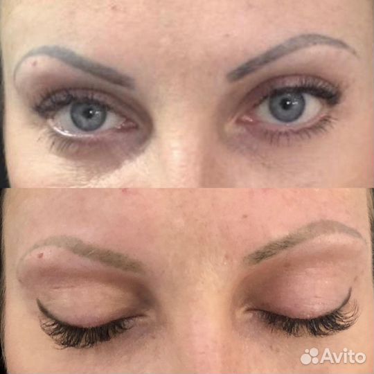 Удаление татуаж,тату и пигментных пятен