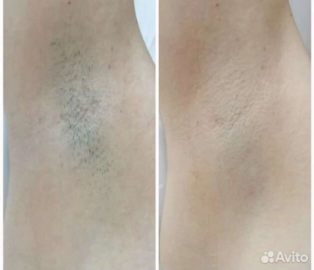 Лазерная эпиляция