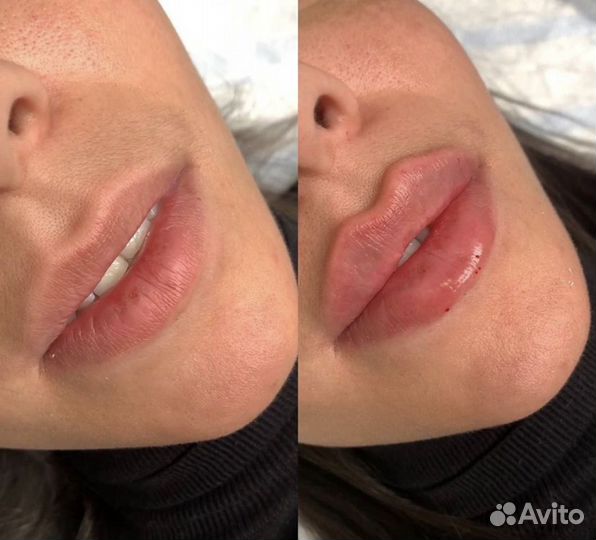 Увеличение губ скулы углы Джоли фулфейс