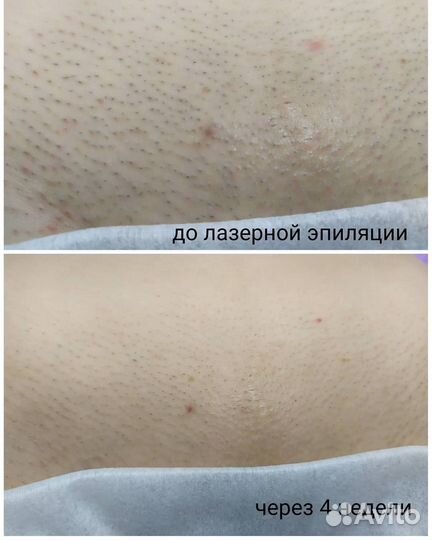 Лазерная эпиляция