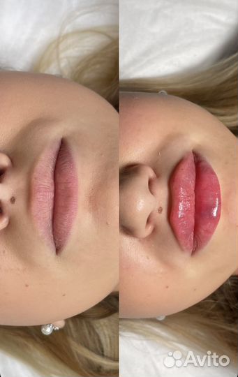 Косметолог, увеличение губ, биоревитализация