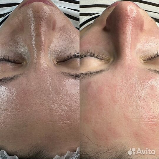 Карбокситерапия