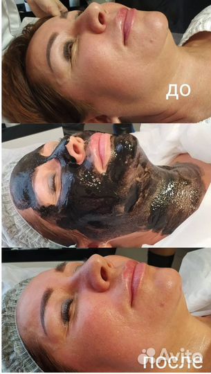 Модели на Карбоновый пилинг лица бесплатно