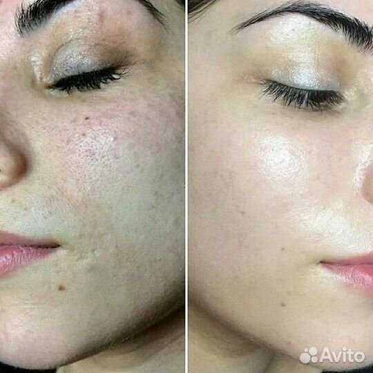 Косметолог чистка лица