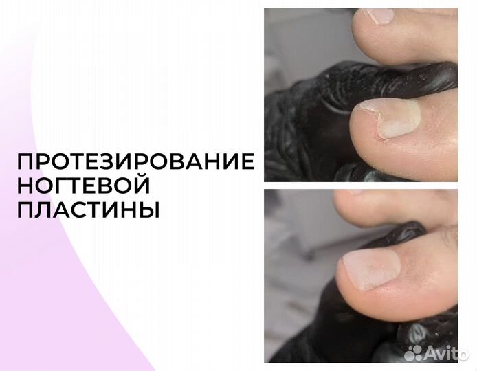 Подолог. Вросший ноготь. Мозоли. Бородавки/Педикюр