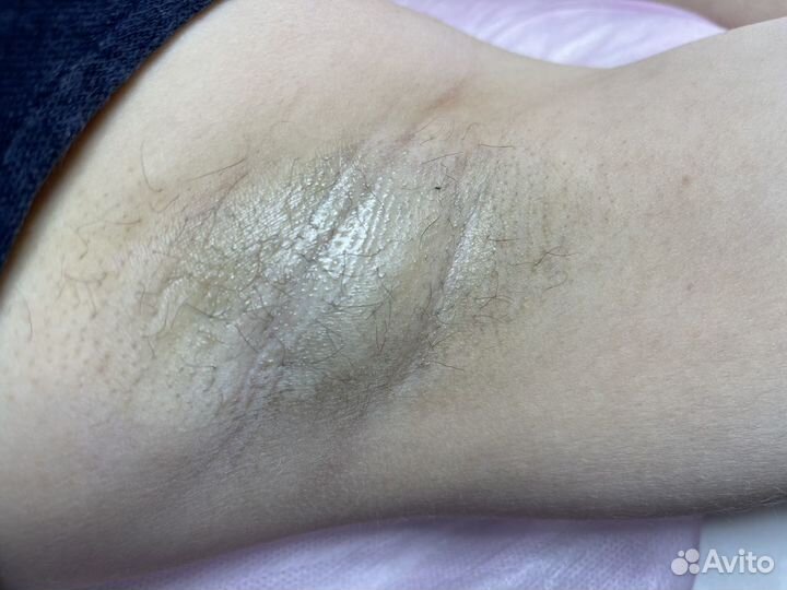 Электроэпиляция - удали навсегда волосы