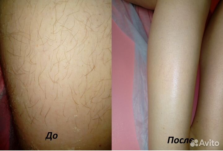 Шугаринг, ваксинг (воск) Уралмаш