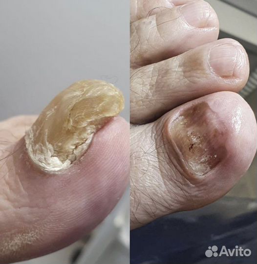 Подолог (сложные ногти и стопы)