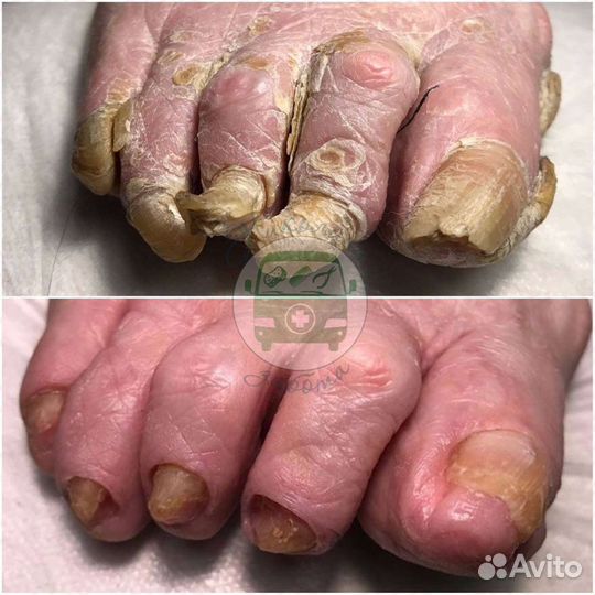 Подолог,медицинский педикюр,педикюр пожилым. Выезд