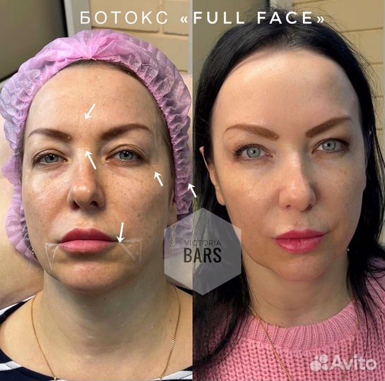 Ботокс для лица / Косметолог