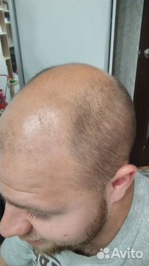 Трихопигментация головы SMP