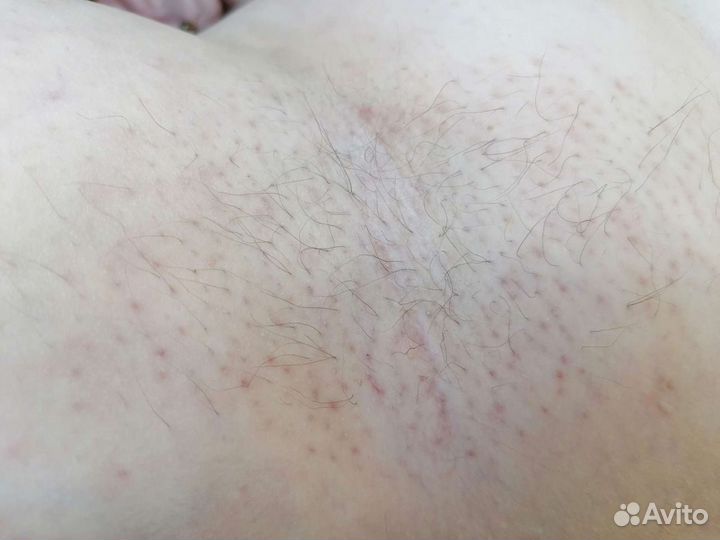Электроэпиляция