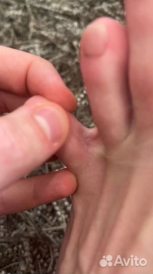 Подолог: Вросший ноготь. Мозоли. Трещины. Грибок