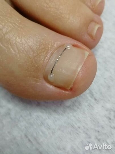 Аппаратный педикюр