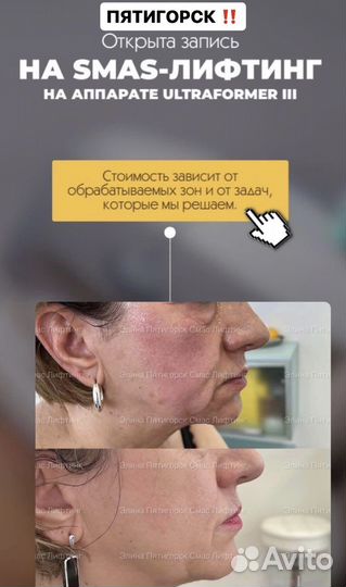 СМАС лифтинг Подтяжка лица уход за лицом