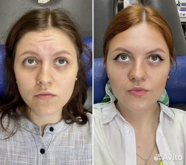 Ботокс (Бутулинотерапия) botox