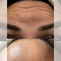Ботокс Full Face, Видное