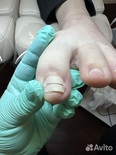 Педикюр, подолог,вросший ноготь, трещины,мозоли