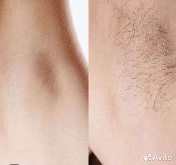 Лазерная эпиляция