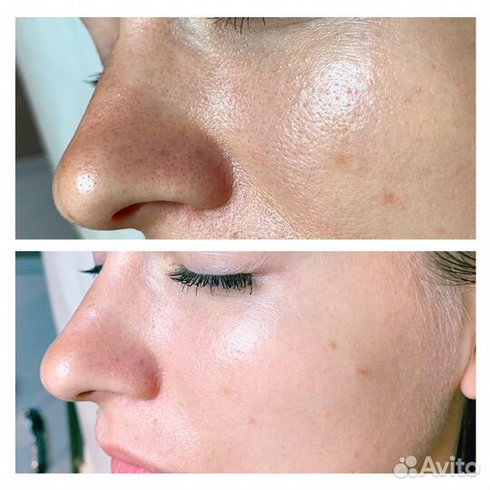 Карбоновый пилинг