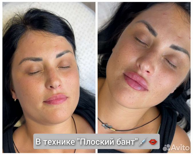 Увеличение губ