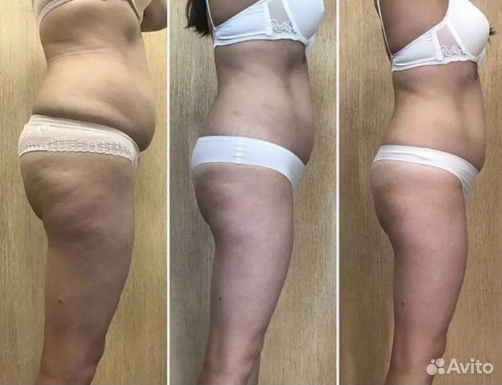 LPG массаж, косметолог- эстетист.12 квартал