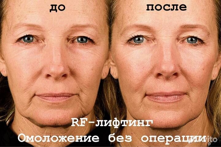 RF лифтинг - красивое лицо без инъекций