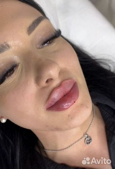 Увеличение губ скулы углы Джоли фулфейс