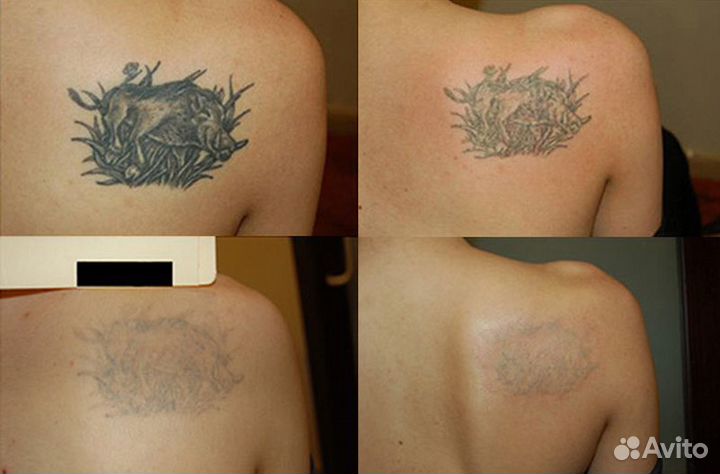 Лазерное удаление тату и ПМ, карбоновый пилинг