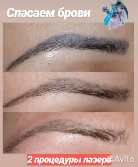 Удаление татуировок и татуажа