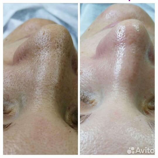 Чистка лица